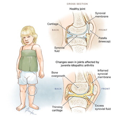 What is polyarticular juvenile idiopathic arthritis (JIA)?
