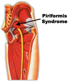 Piriformis Syndrooma